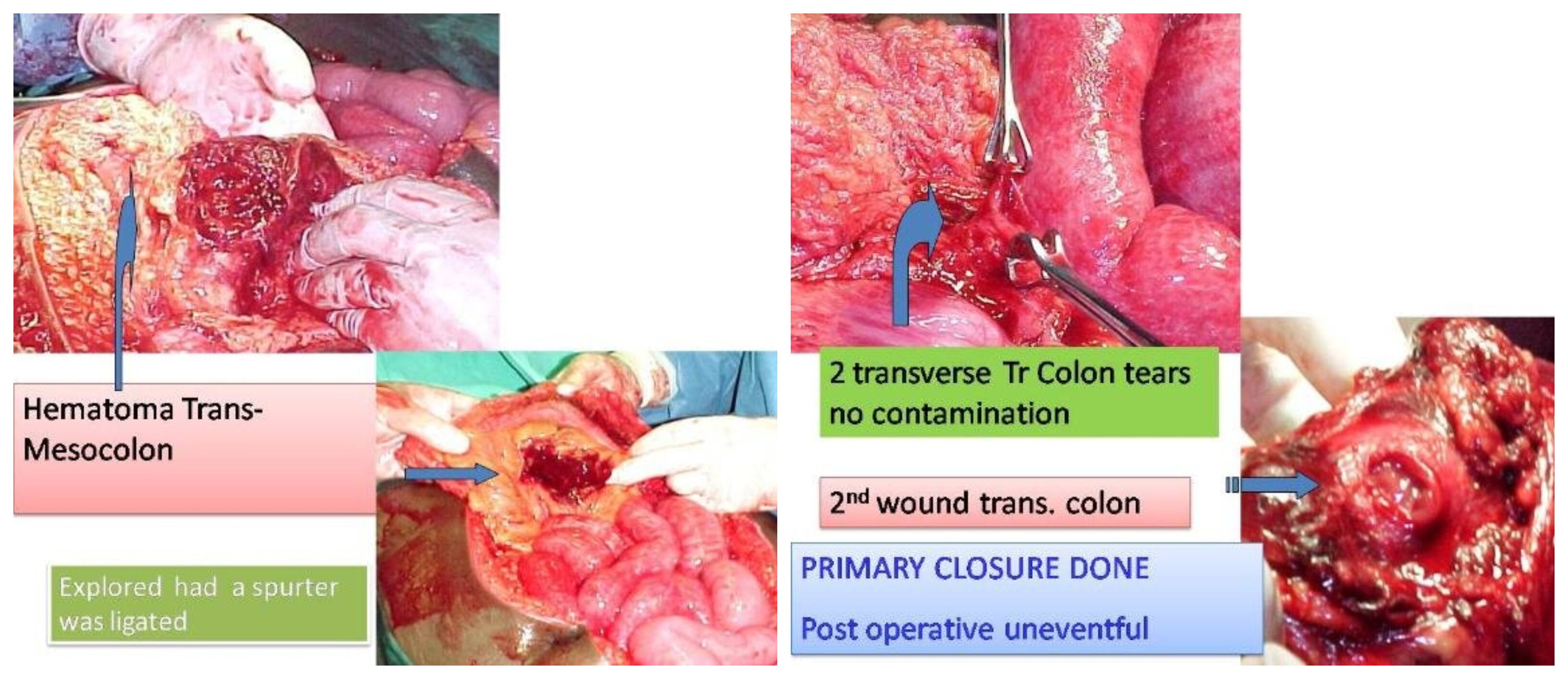 Stab Injury Abdomen with Large Part of Ileal Protrusion