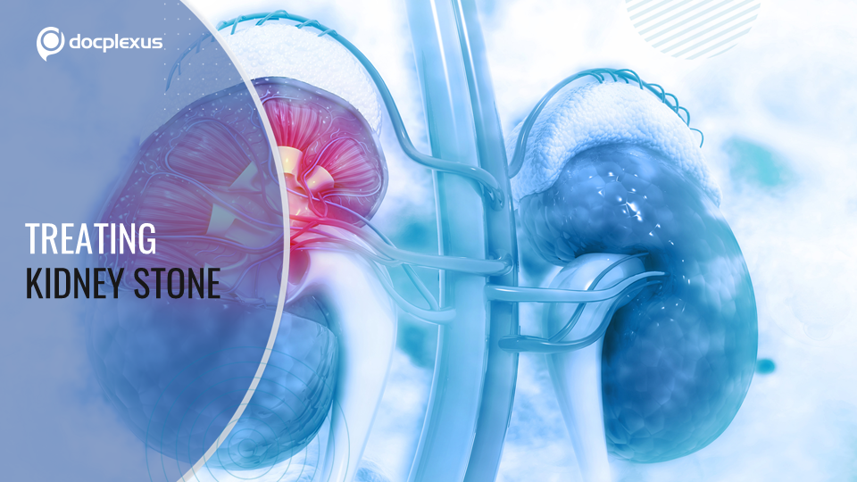 Technique for Treating Kidney Stones