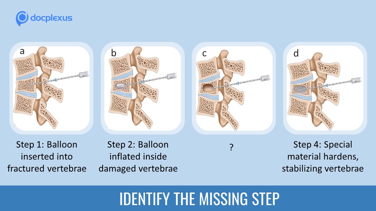 How Well Do You Know Kyphoplasty?