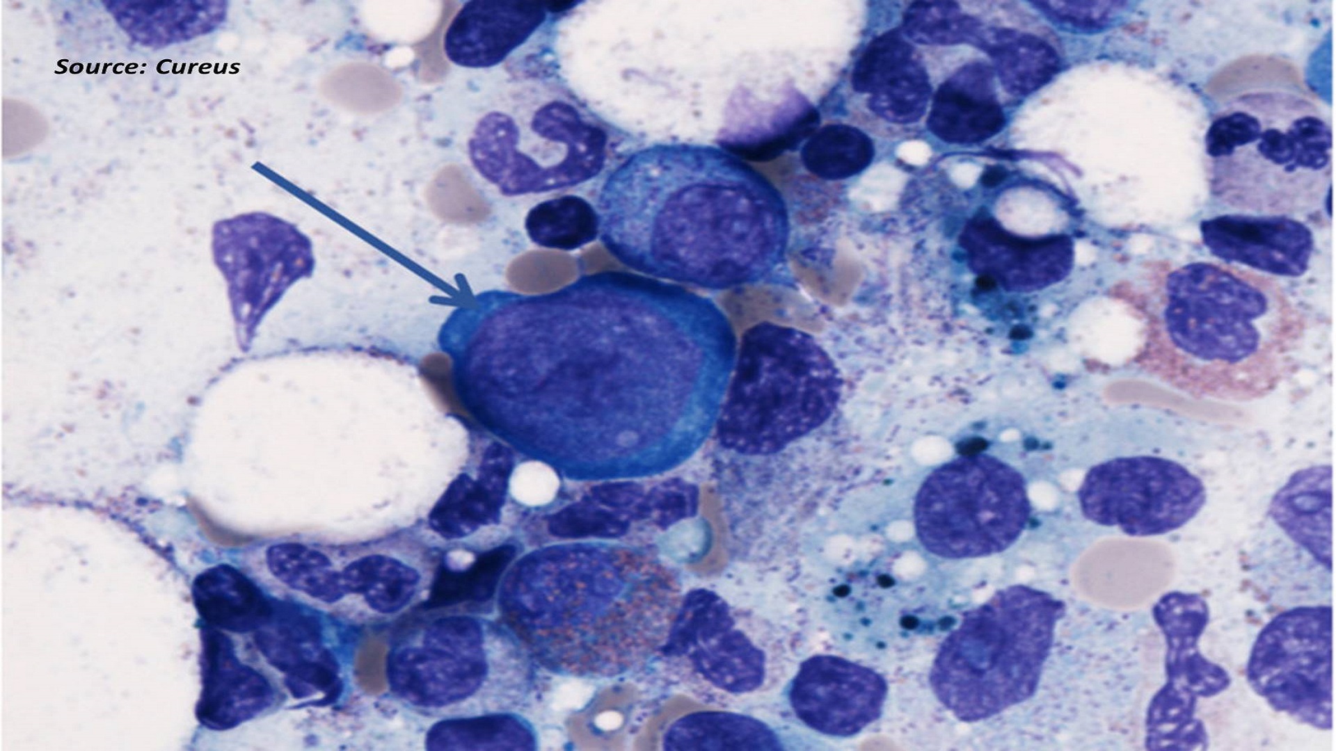 What Has Caused Severe Anemia in This Immunocompromised Patient?