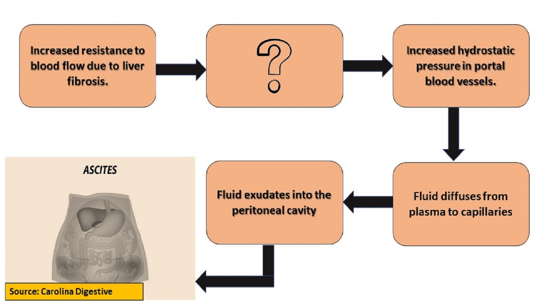 Pathophysiology of Ascites Formation in Liver Cirrhosis