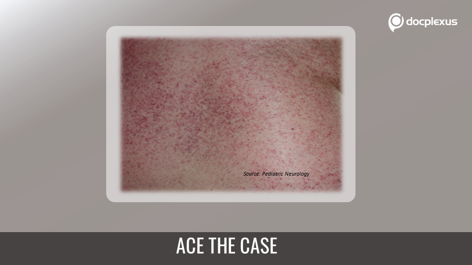 What is the Cause of Excess Ceramide in this Patient?
