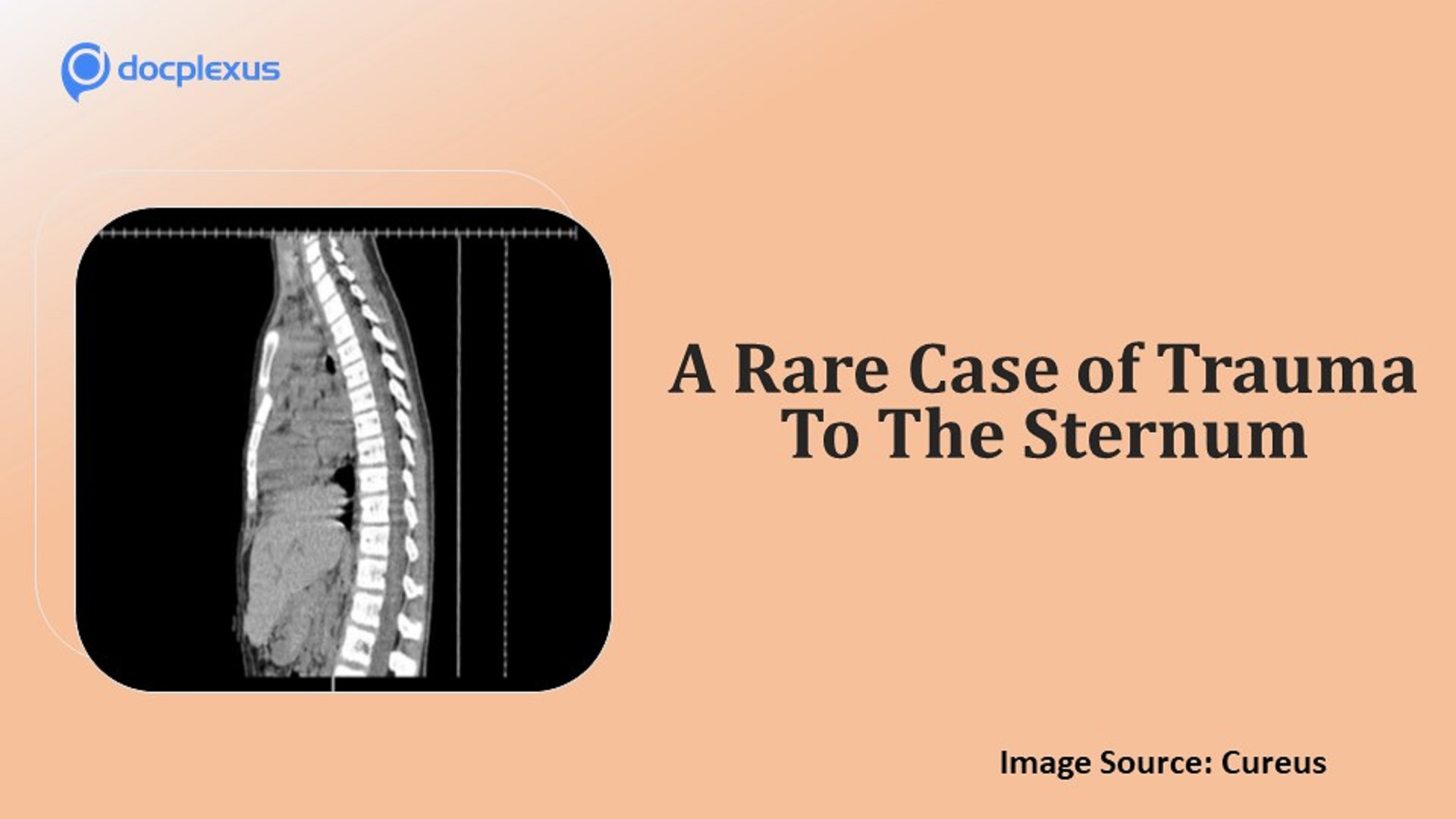Trauma to the Sternum – What’s Your Diagnosis?
