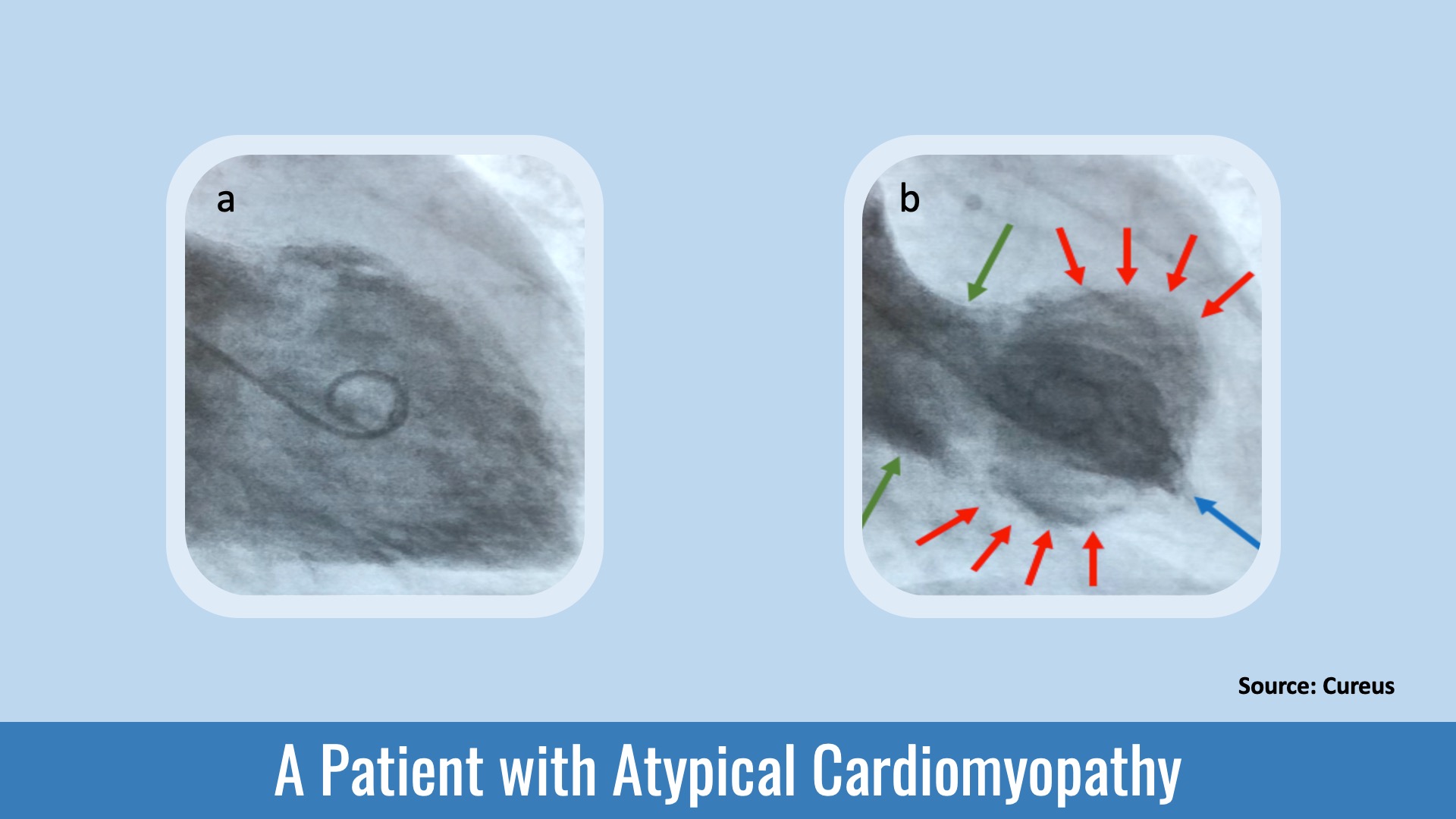Identify the Cause of Midsternal Discomfort in this Patient