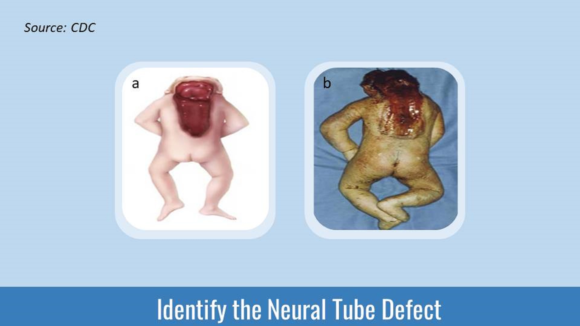 Identify the Neural Tube Defect