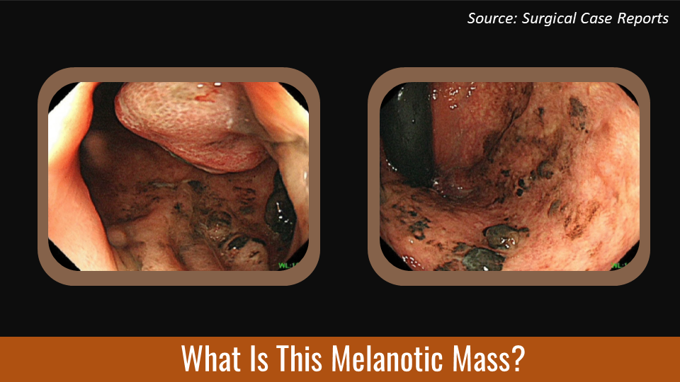 Recurrent Rectal Tumor -  What’s Your Diagnosis?