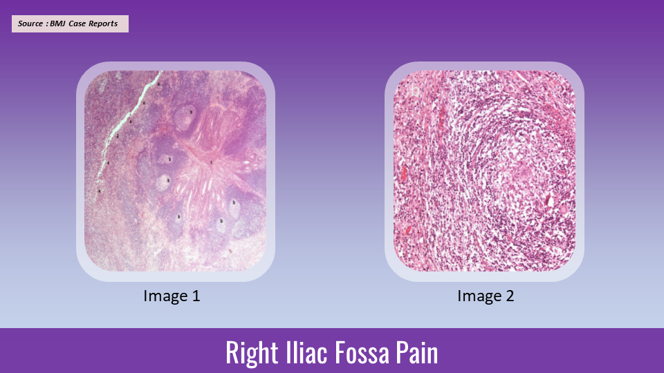 Severe Pain in the Right Iliac Fossa in a Young Athletic Male
