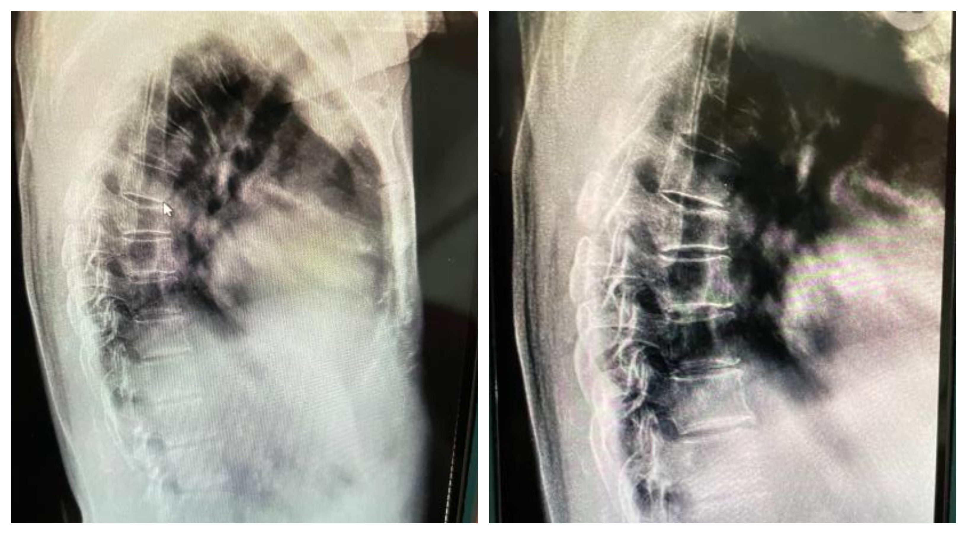 A Sudden Onset of Back Pain
