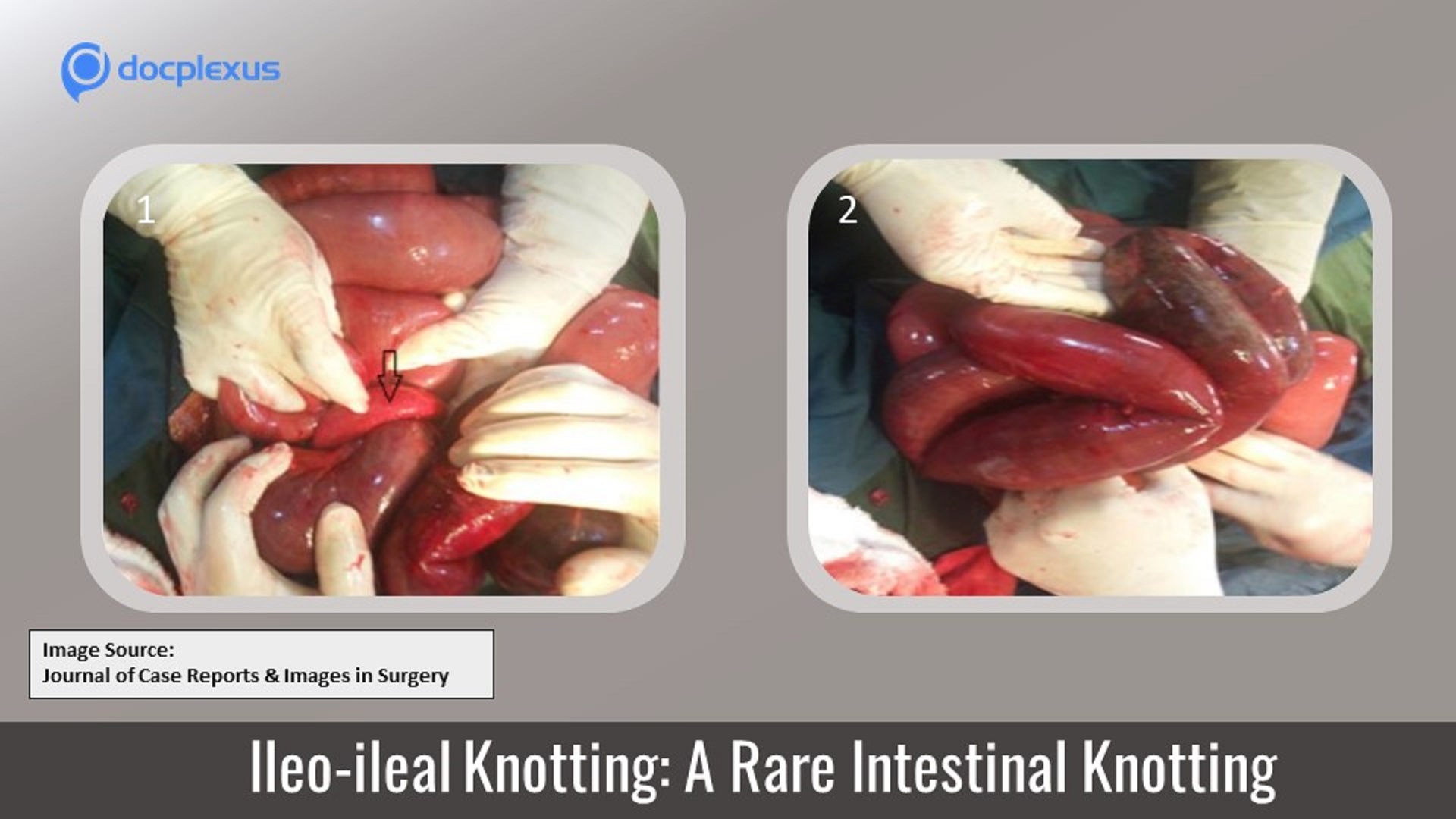 Ileo-Ileal Knotting: A Rare Type of Intestinal Knotting