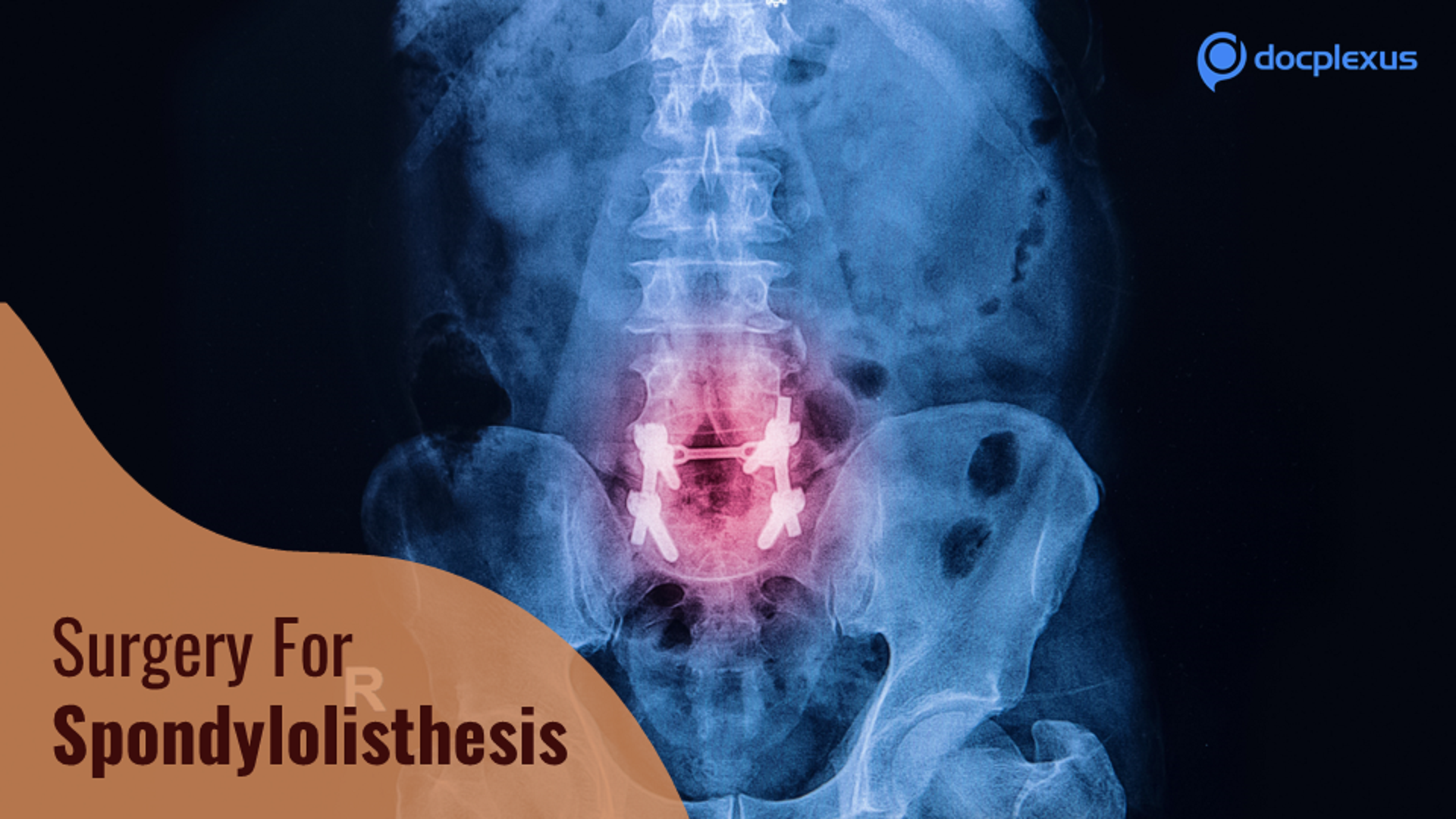 Identify the Best Surgical Intervention for Spondylolisthesis
