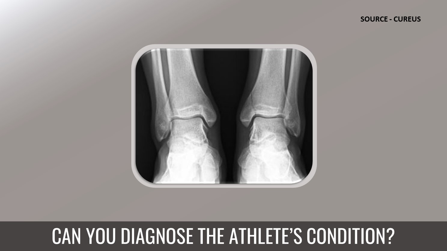 What is the Reason for the Atraumatic Ankle Discomfort?