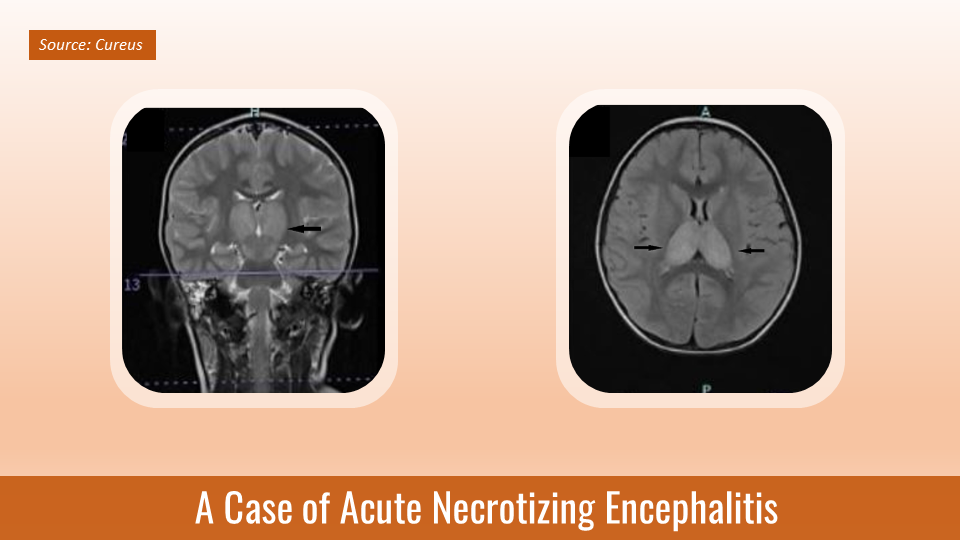 A Case of Rare Neurological Disorder in a 5-year-old Boy