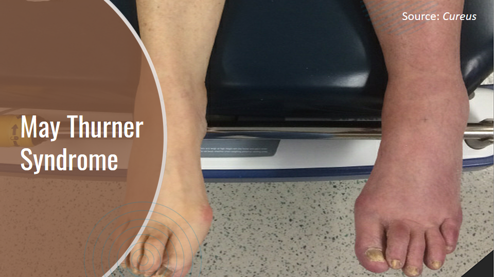 Managing May Thurner Syndrome