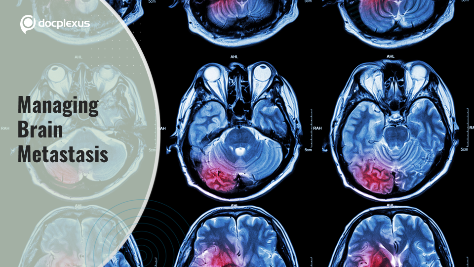 Brain Metastasis Treatment: ASCO Guidelines (2021)