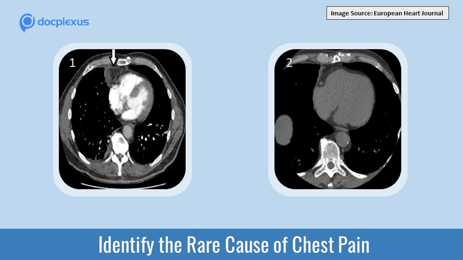 Identify the Rare Cause of Chest Pain