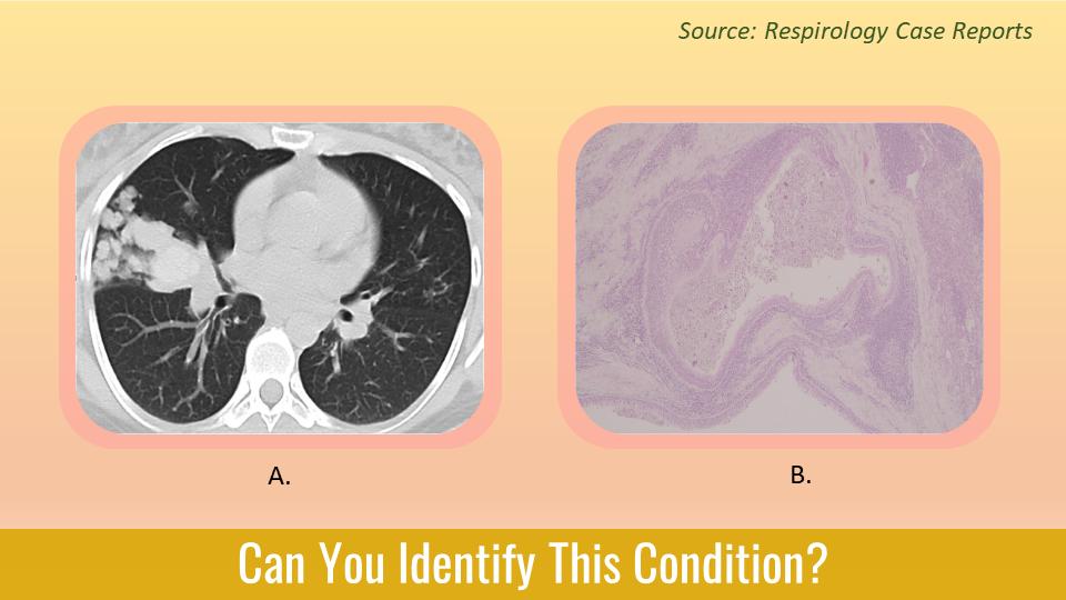 Case of a Young Lady with Chronic Cough – What is Your Diagnosis?