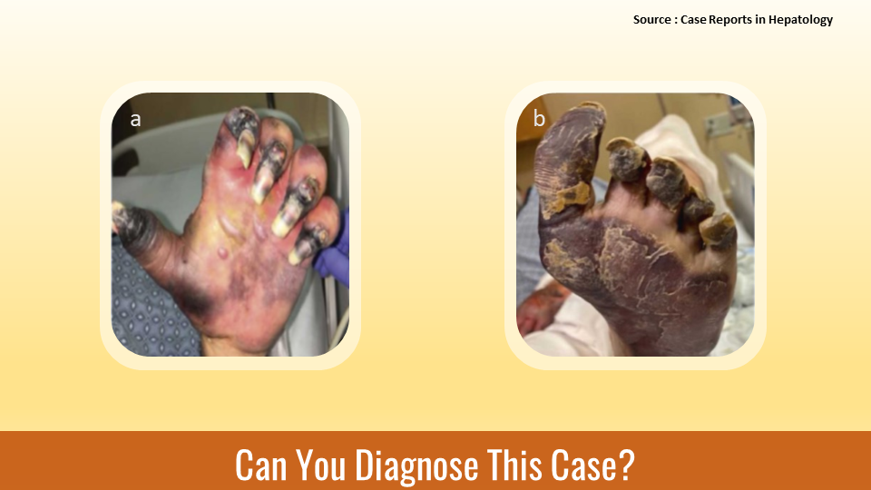 Can You Diagnose This Rare Case of Progressive Gangrene ?