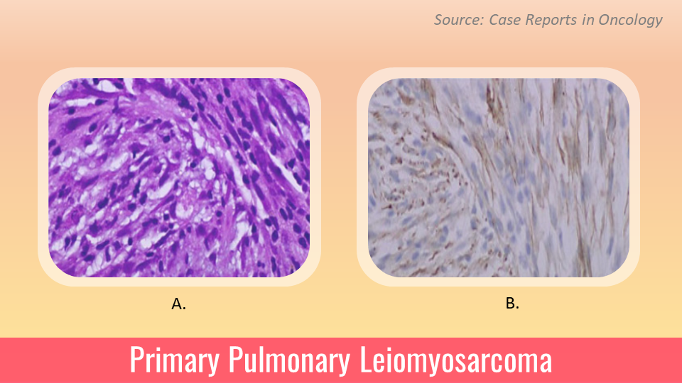 Primary Pulmonary Leiomyosarcoma – A Rarity