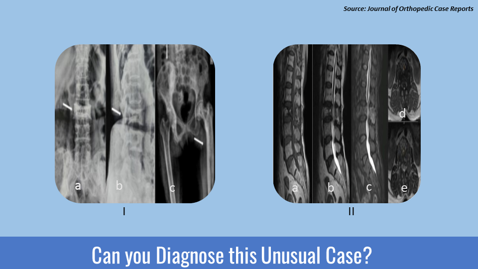 Ace This Rare Case of Co-existence of Metabolic Bone Disease and Neurological Deficit