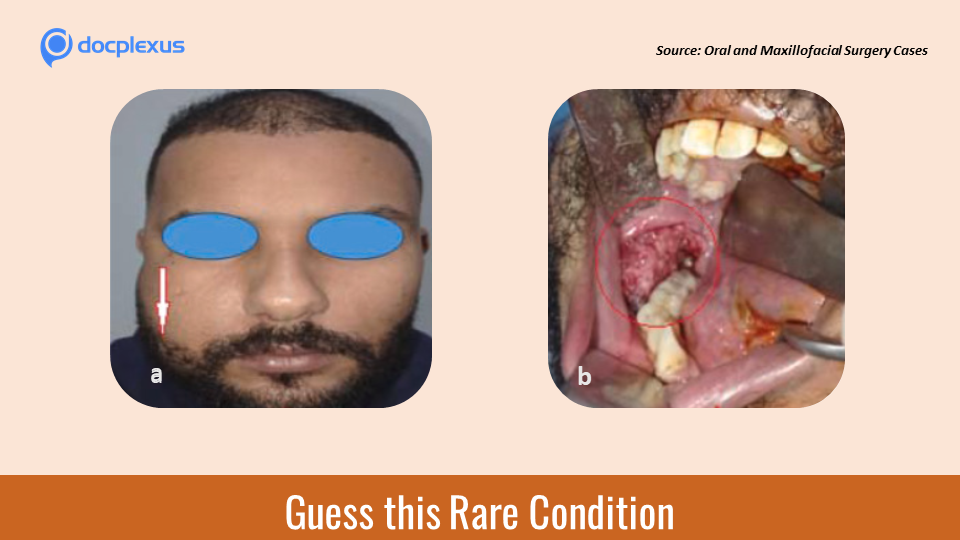 A Rare Case of Mandibular Lump in a Young Man