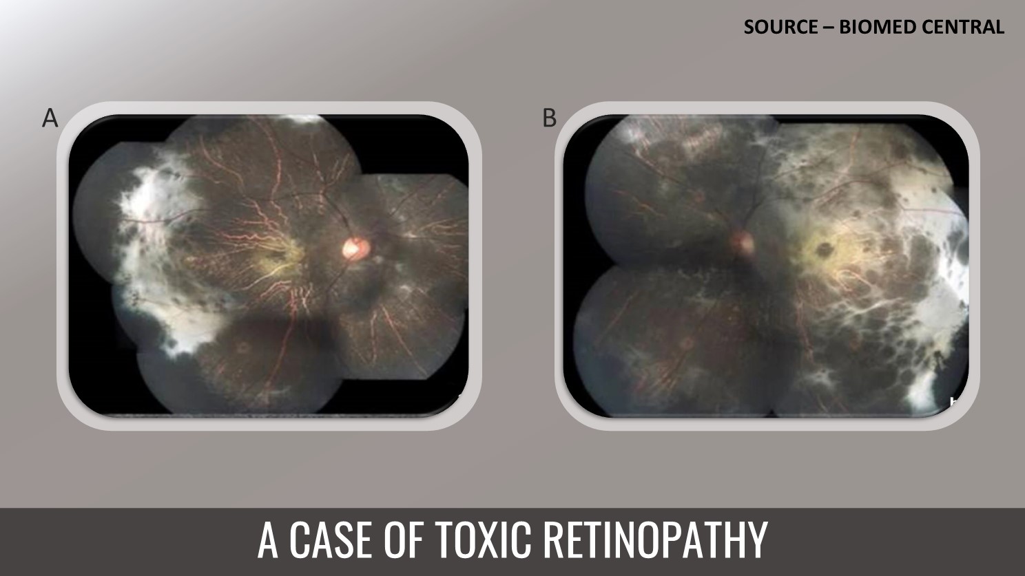 Identify the Reason Behind Toxic Retinopathy in This Patient