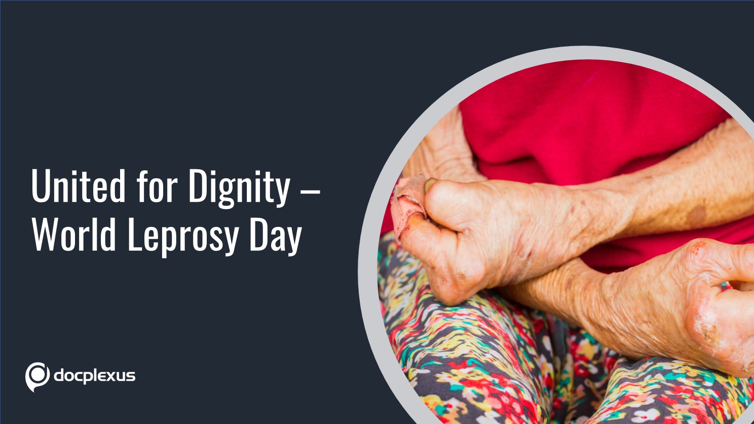 World Leprosy Day: Putting an End to the Stigma