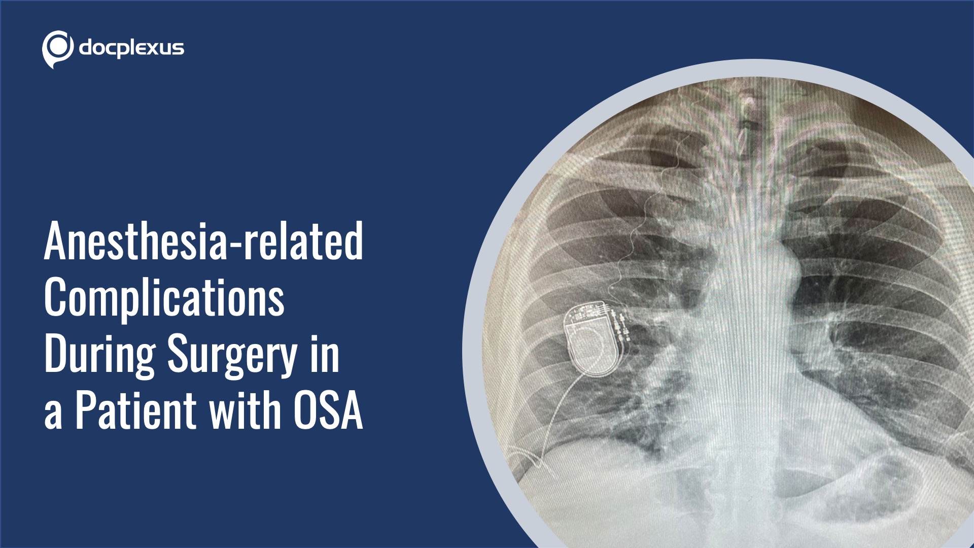 Implanted OSA Device and Anesthetic Complications