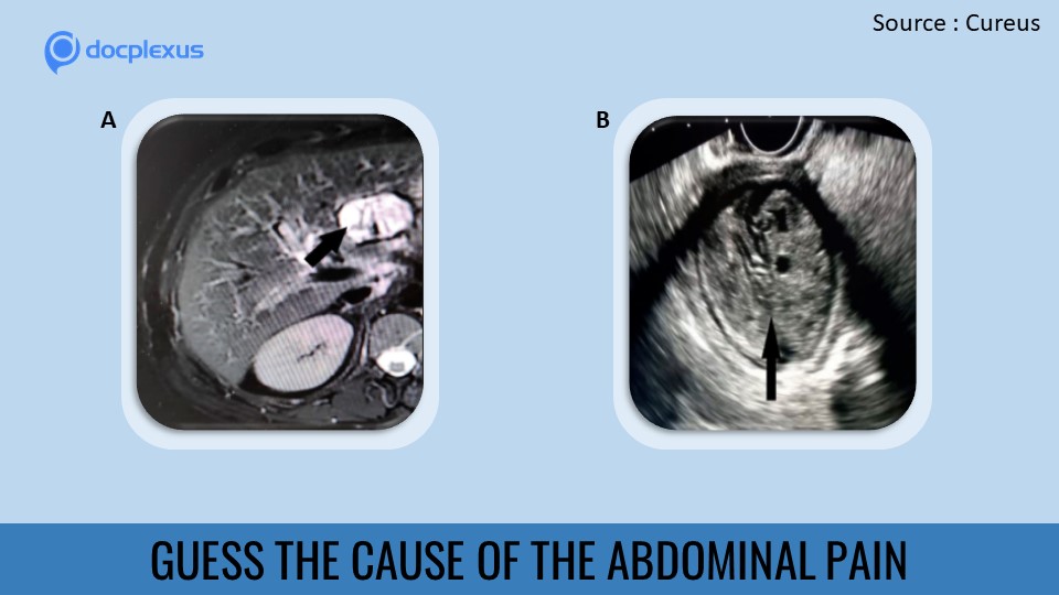 Identify the Reason Behind Abdominal Pain