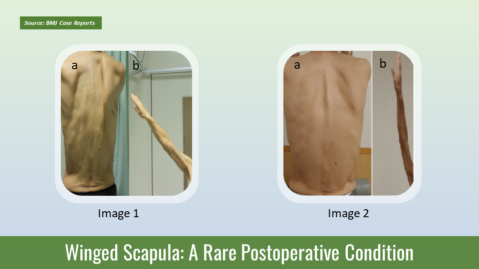 Identify the Cause of Post-thoracotomy Winged Scapula in This Patient