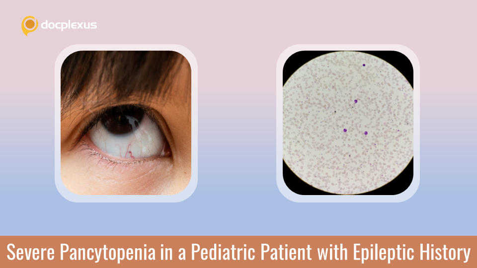 Rare Cause of Pancytopenia in an 11-year-old with Autism Spectrum Disorder and Dravet Syndrome