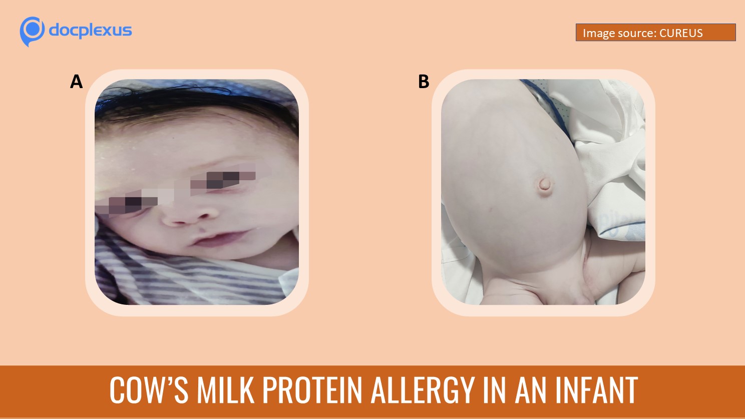 Cyanosis in an Infant with Cow’s Milk Protein Allergy