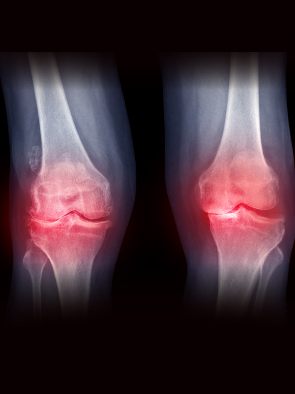 TKR in Varus deformities