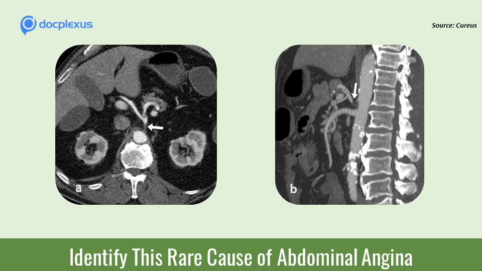 What’s Causing Burning Abdominal Pain in This 65-year-old Man?