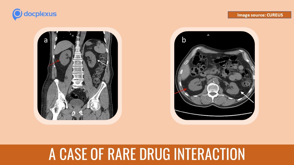 Diagnose This Condition Caused Due to Multi-drug Interaction