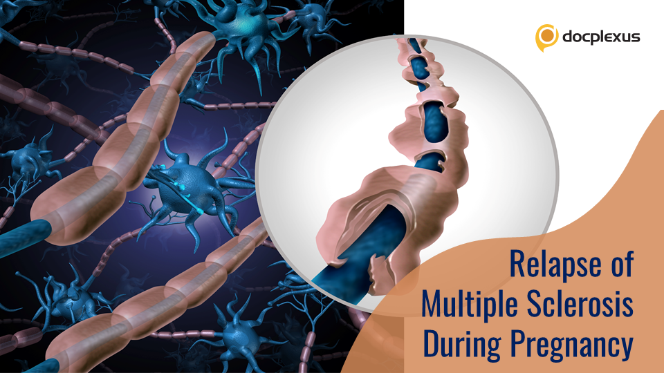 Natalizumab for Treating Pregnancy-related Multiple Sclerosis Relapse