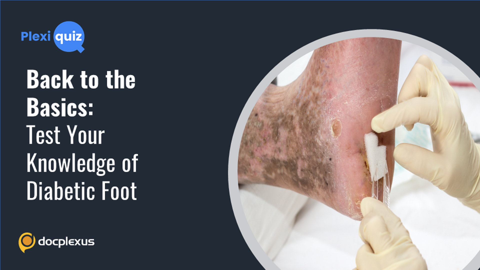 Test Your Knowledge of Diabetic Foot Through This Quiz!