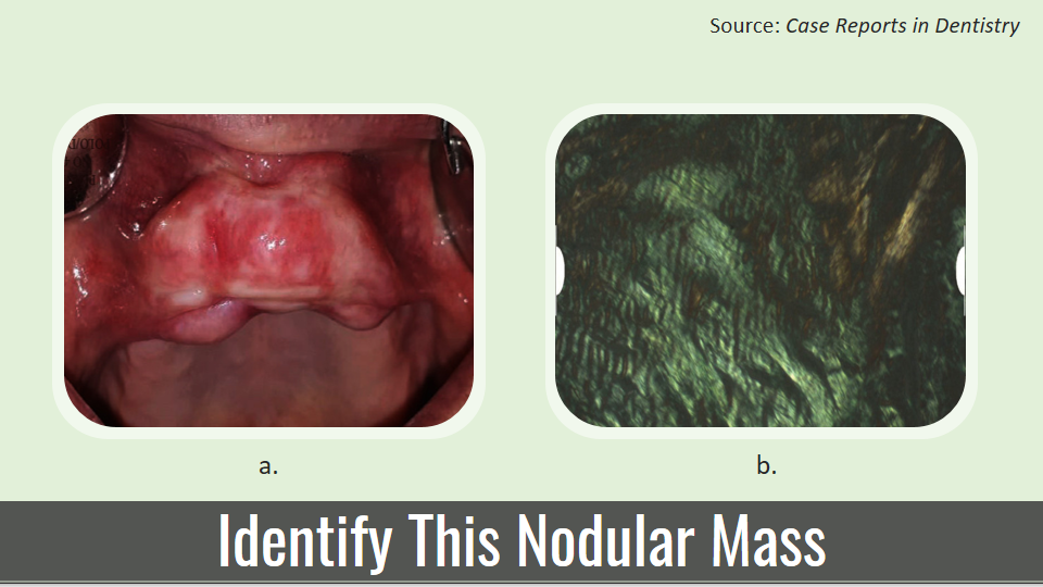 Identify This Non-tender Nodular Mass in the Pre-maxillary Region