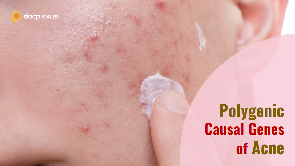 Newly Identified Acne Gene Loci and Their Polygenicity