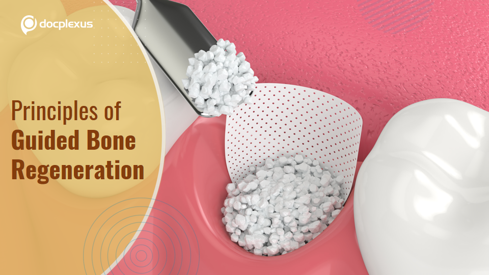 The Four Principles of Guided Bone Regeneration