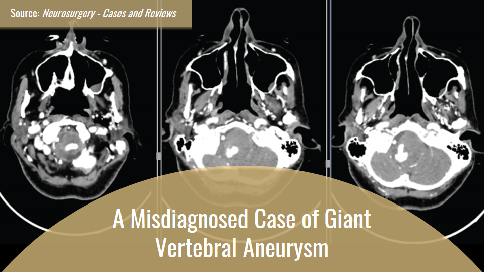 Cough and Dyspnea to Aid in the Diagnosis of Giant Vertebral Aneurysm