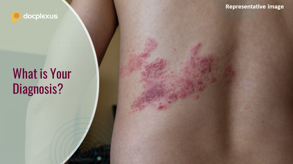 Painful Erosive Mucocutaneous Lesions in a Middle-aged Man – What’s Your Diagnosis?