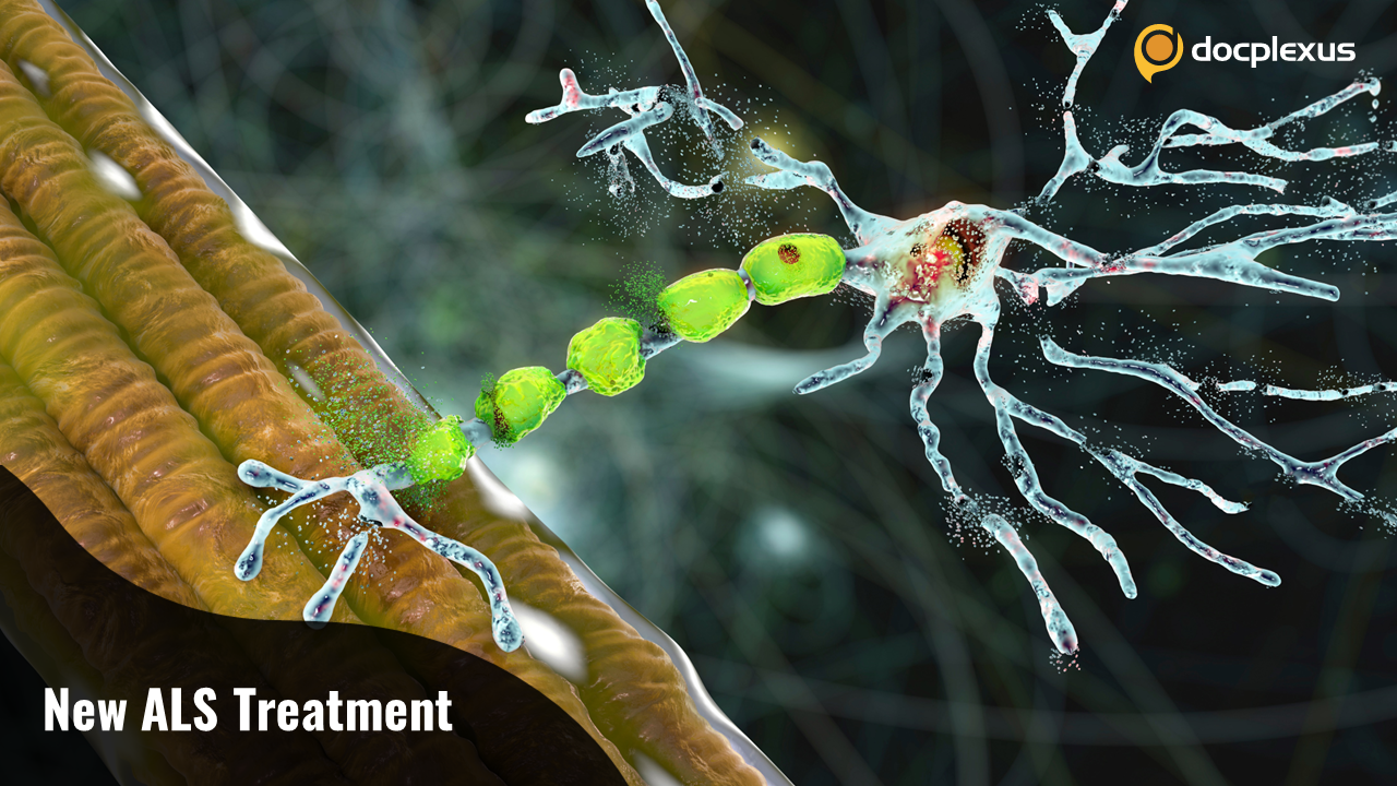 USFDA Approves Treatment for ALS