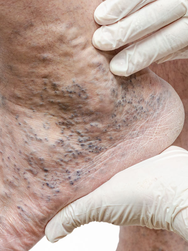 Compression Therapy in Venous Ulcers