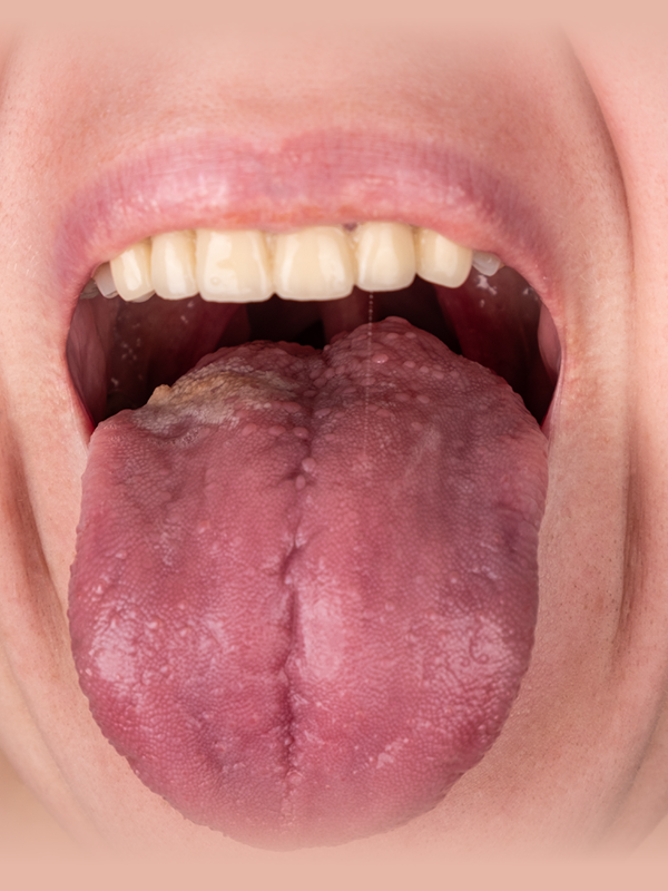Management of Early and Advanced Tongue Cancers