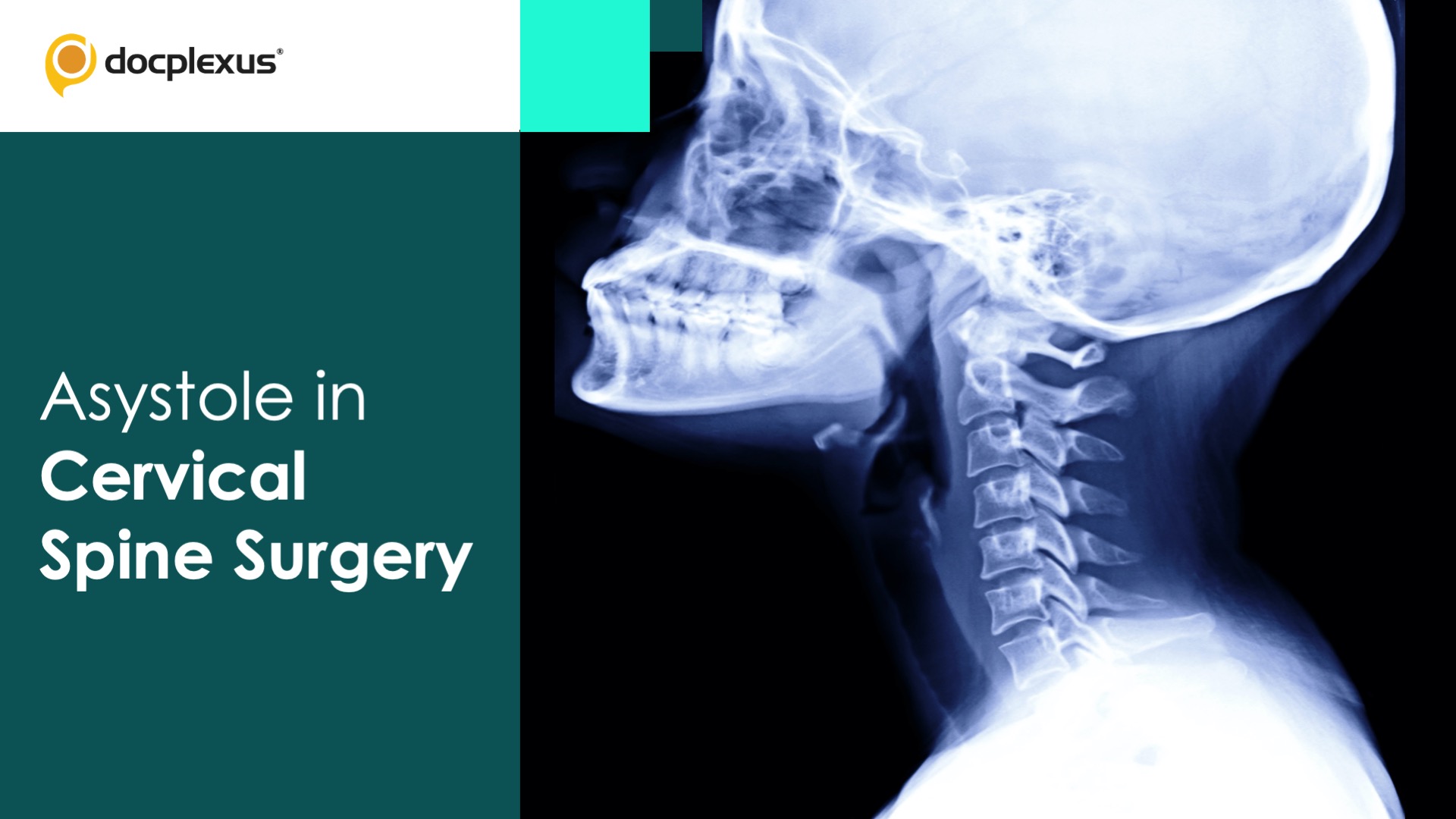 An Incidence of Asystole During Cervical Spine Surgery