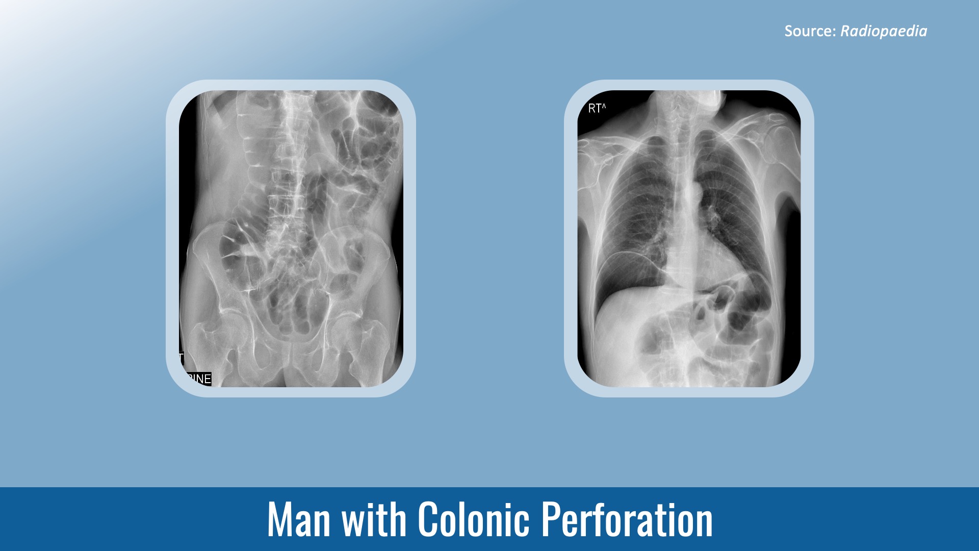 Man with Colonic Perforation