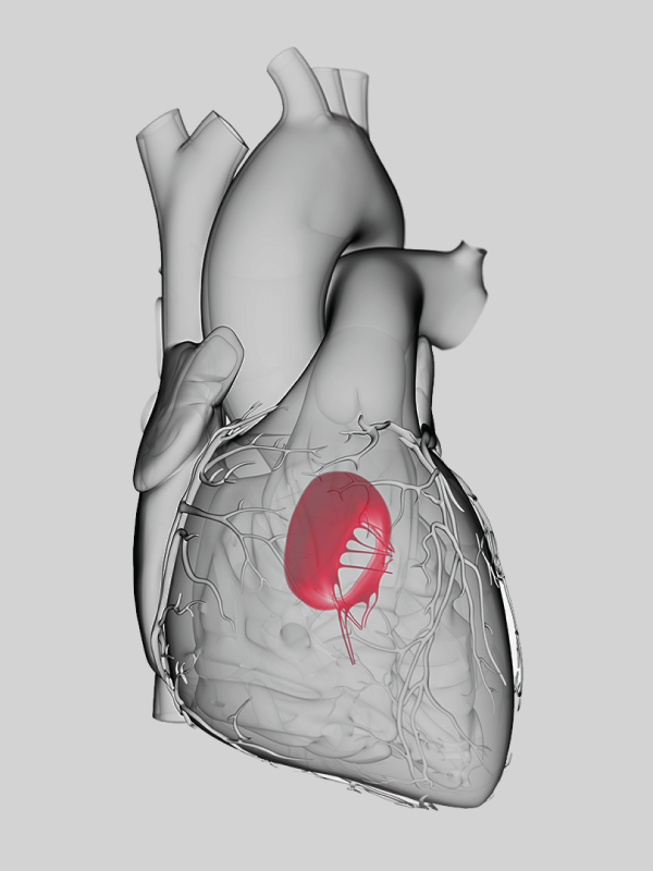 Endoscopic Mitral Valve Surgery