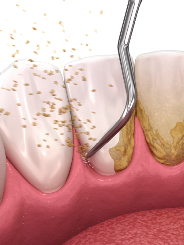 Nonsurgical Periodontal Therapy and Management of Dentinal Hypersensitivity