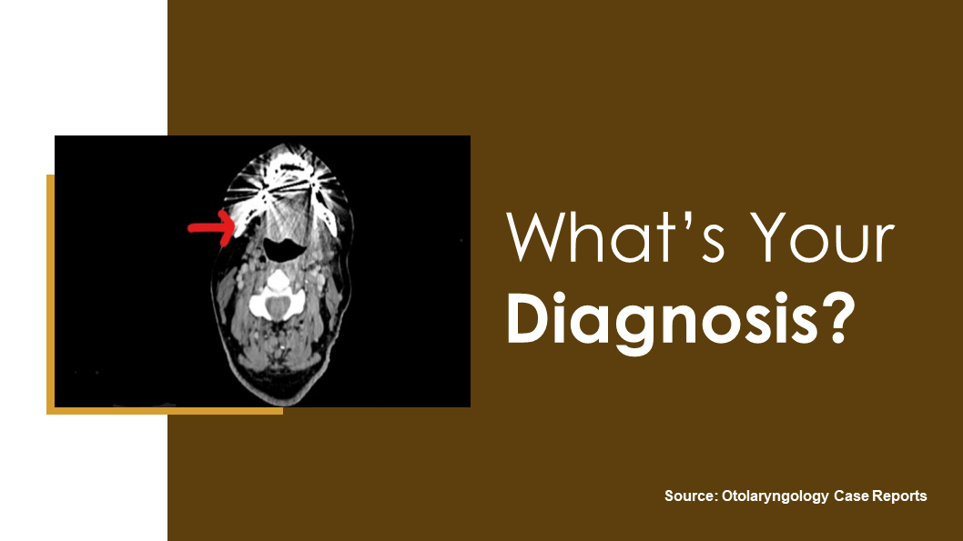 What Could be the Cause of this Oropharyngeal Bleeding?