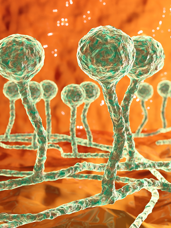 Patient-specific Implants - A Breakthrough Option for Post-mucormycosis Rehabilitation
